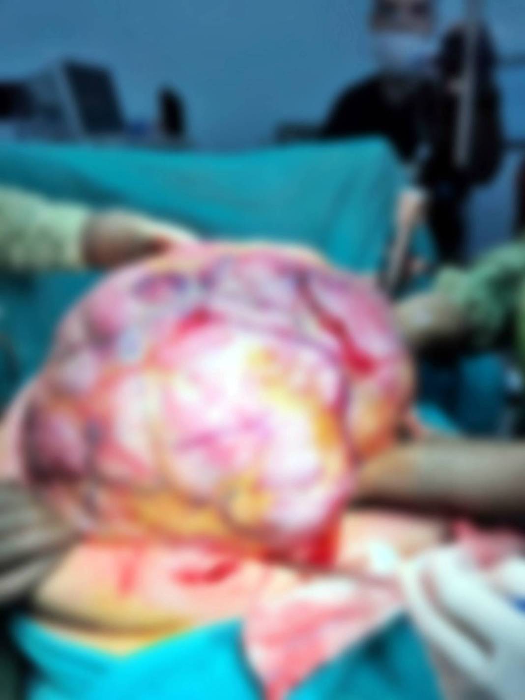 Doktor şaştı kaldı: Bu kadar büyüğünü daha önce görmedim! Hastanın karnından çıkan dev tümör şoke etti 4